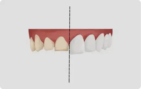 Smile makeover results from Albania cosmetic dentistry clinic