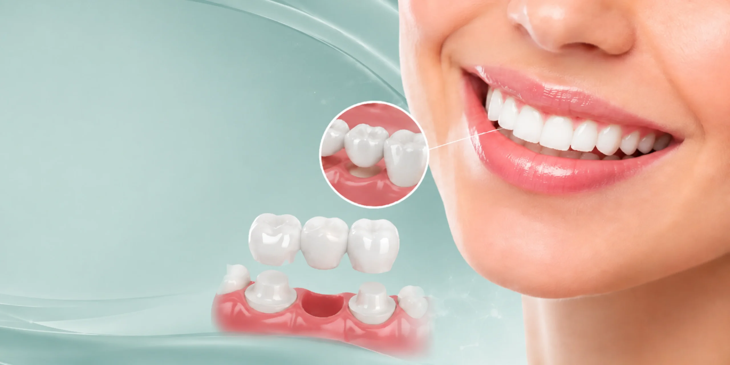 Dental implants in Albania with All-on-4 and All-on-6 treatment at Andent Dental Clinic Tirana