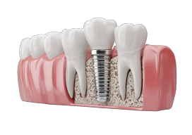 Dental Crowns