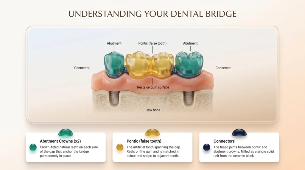 Diagram of a three-unit dental bridge showing the two outer abutment crowns anchored to natural teeth and the central pontic tooth bridging the gap above the gum line.