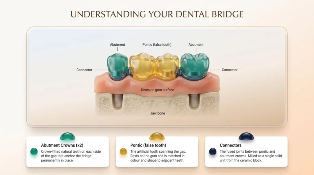 Diagram i një ure dentare me 3 njësi me kurora mbështetëse mbi dhëmbë natyralë dhe pontik qendror mbi mishrat