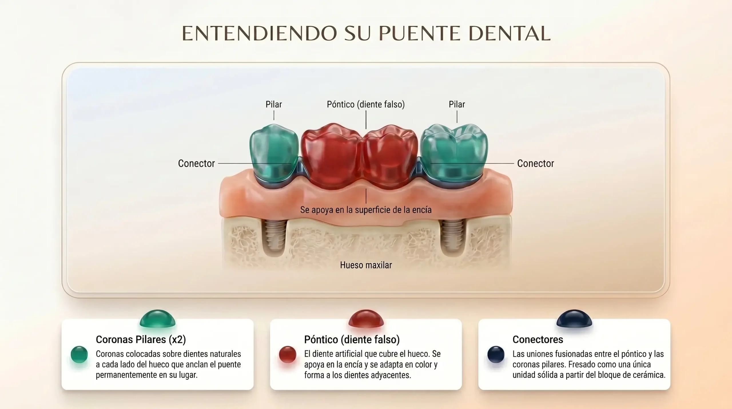 Diagrama de puente dental de tres piezas con coronas pilar y póntico