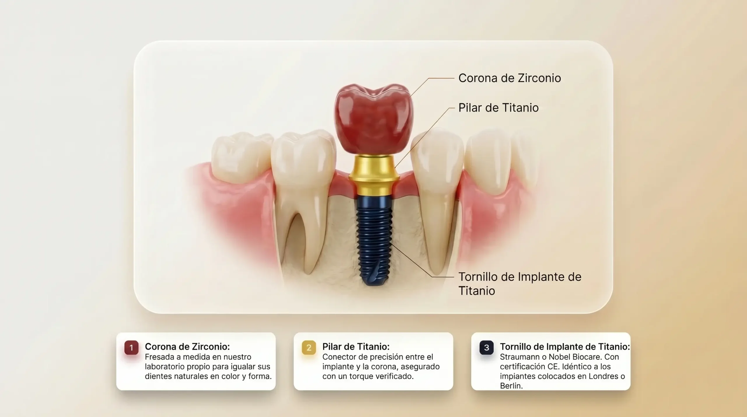 Diagrama de implante dental con corona, pilar y tornillo de titanio